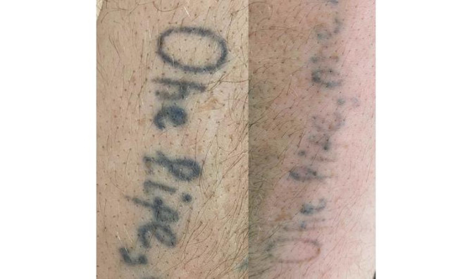 Удаление тату и татуажа Рудный - изображение 4