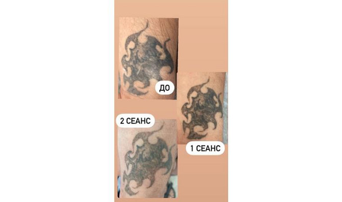 Удаление тату и татуажа Рудный - изображение 2